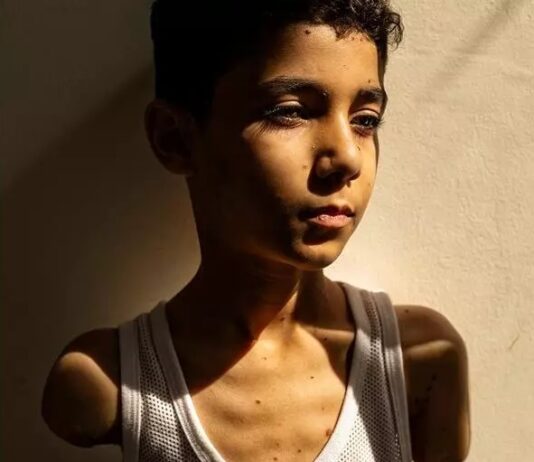 Genocidio sin fin (XVI): Gaza es el lugar con más niños amputados en la historia moderna Niño amputado