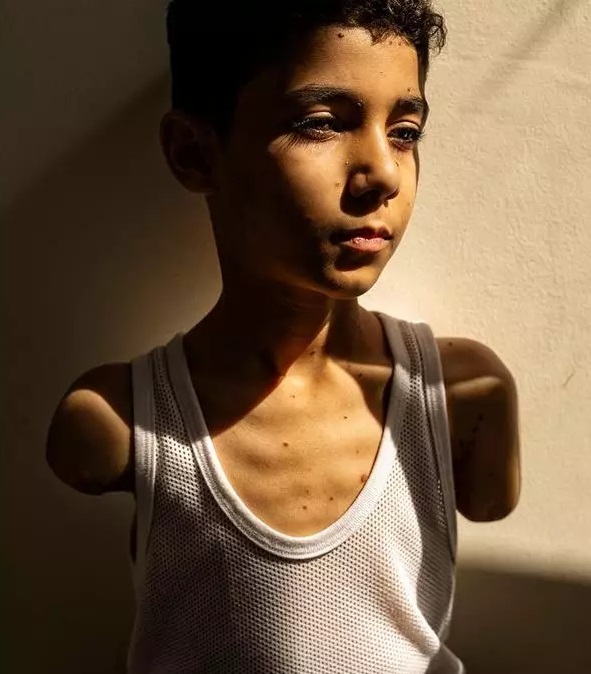 NiñoAmputado Niño amputado